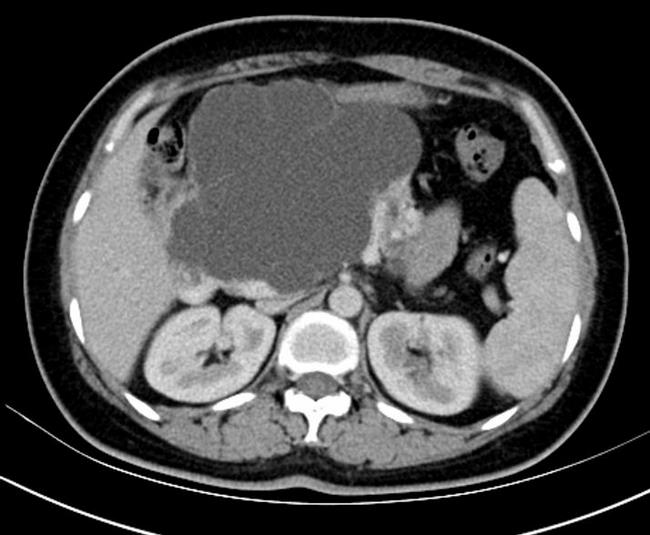 首例腹腔鏡胰十二指腸切除患者痊愈出院(圖3)